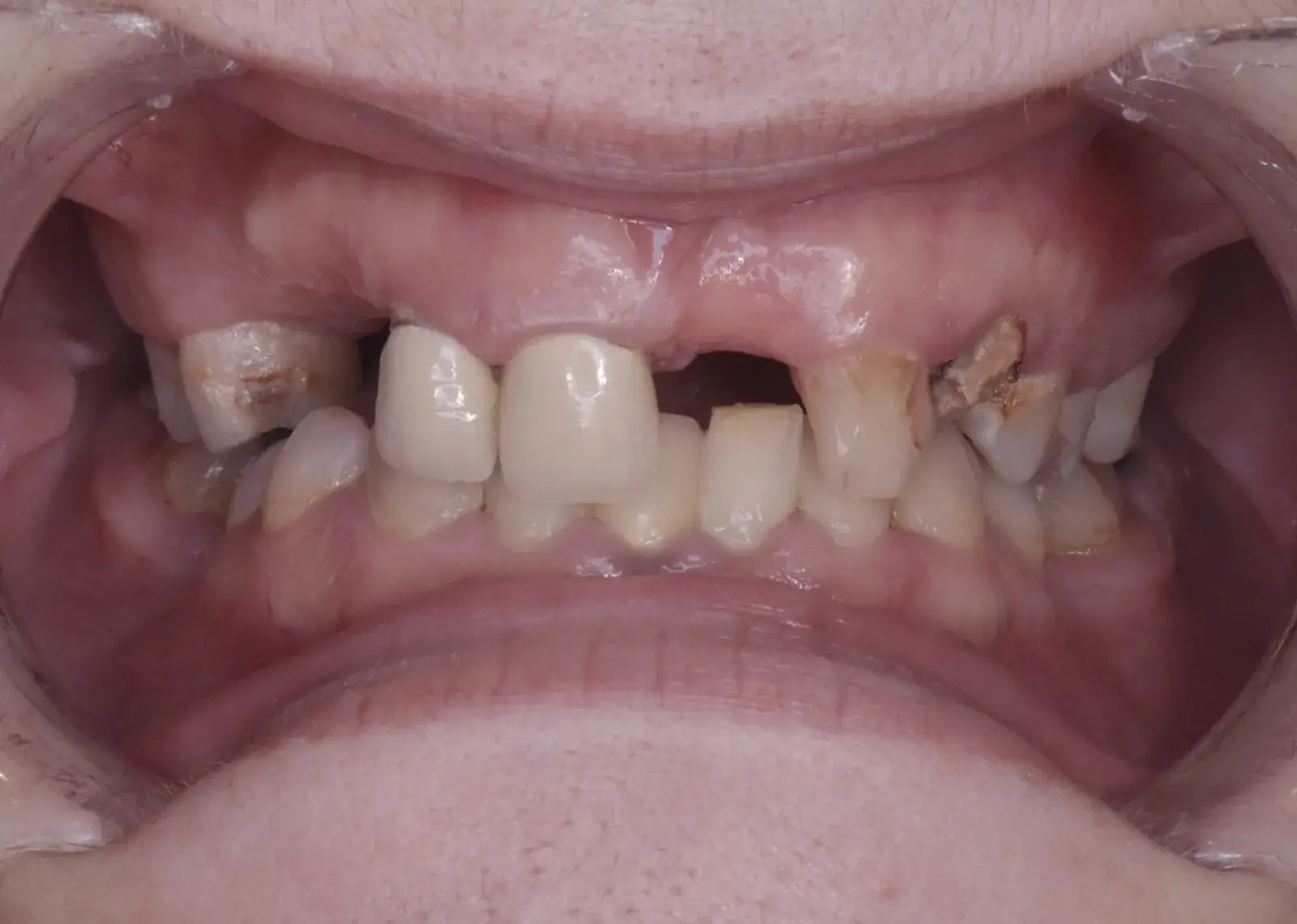Samantha Wilkin – Before