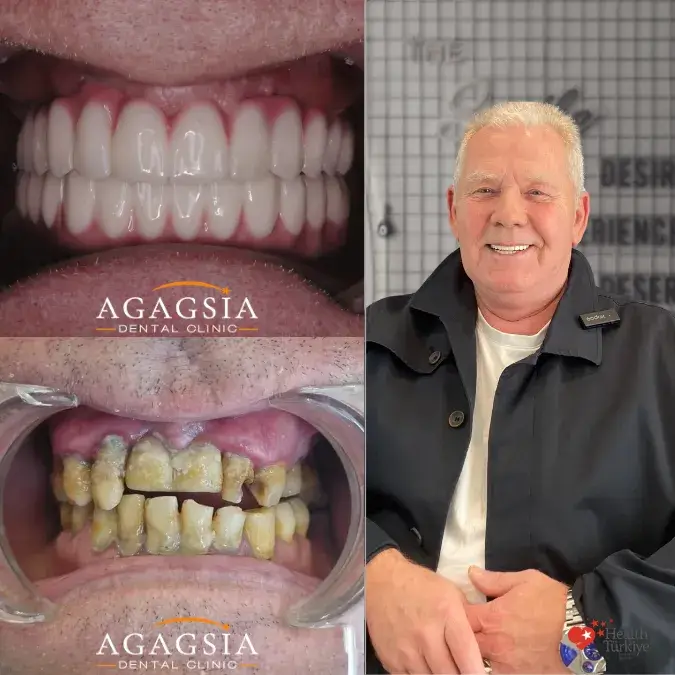 Before & After – All-on-6
