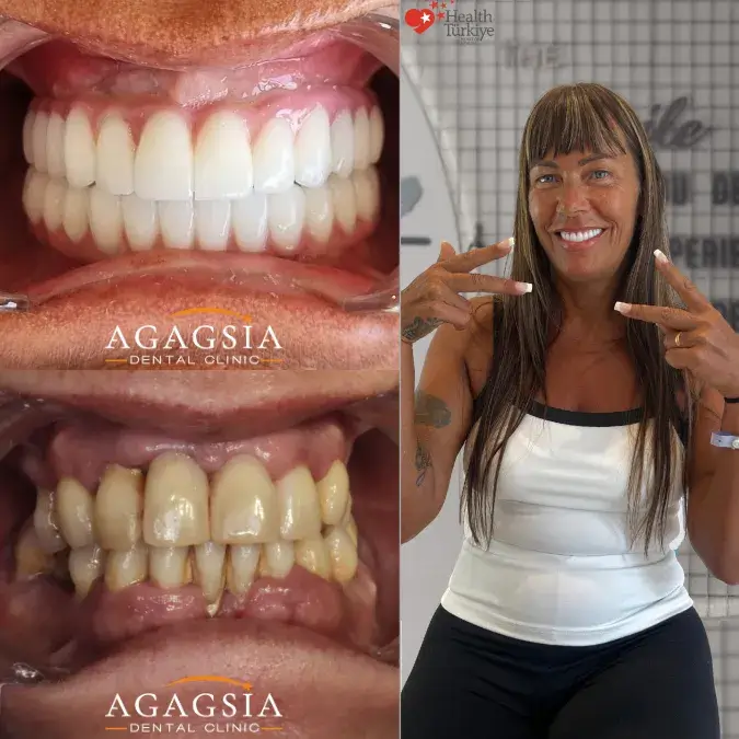 Before & After – All-on-6
