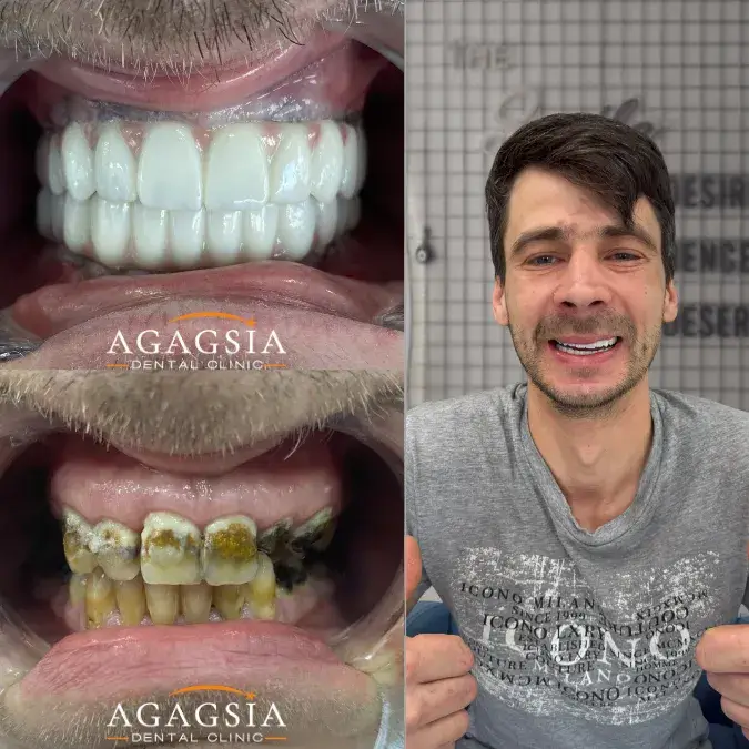 Before & After – All-on-6