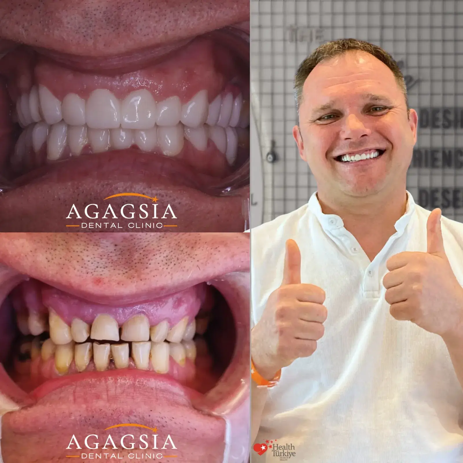 Before & After – Smile Makeover