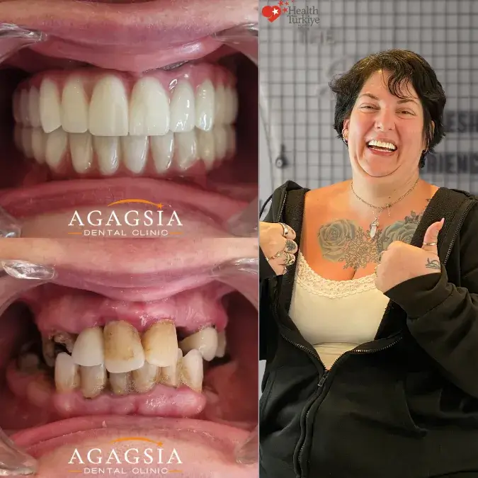 Before & After – All-on-6
