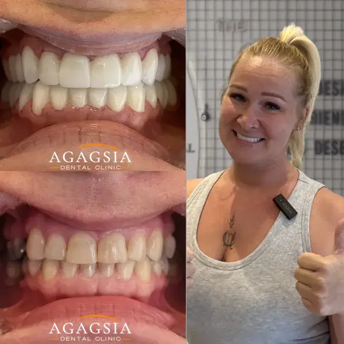 Before & After – Smile Makeover