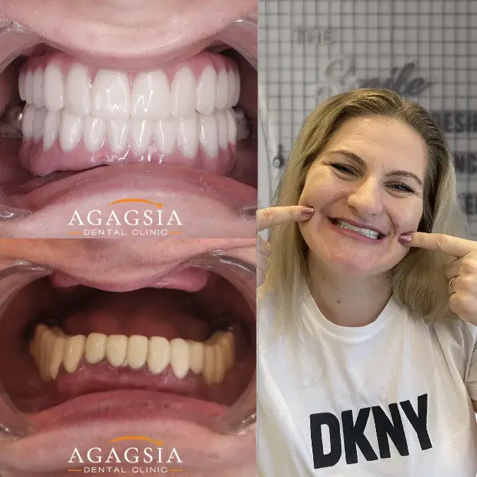 Before & After – All-on-6