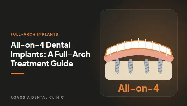 All-on-4 Dental Implants: A Full-Arch Treatment Guide