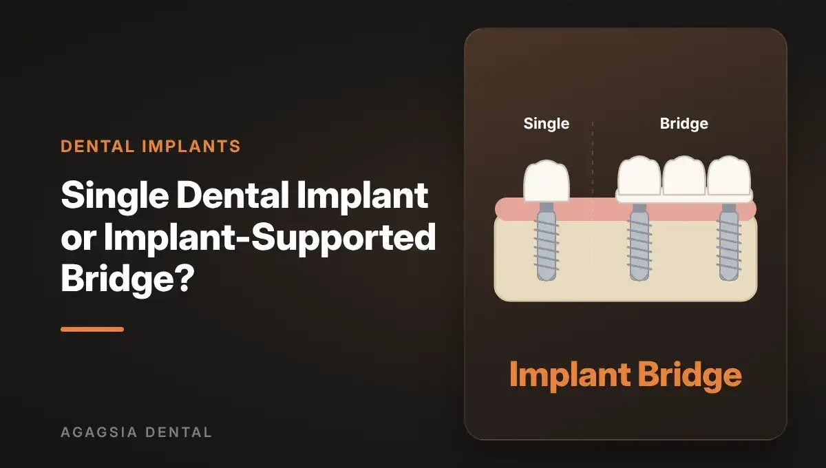 Single Dental Implant or Implant-Supported Bridge?