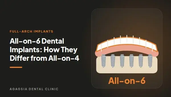 All-on-6 Dental Implants: How They Differ from All-on-4